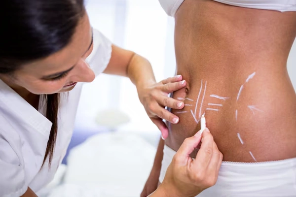 Liposuction
